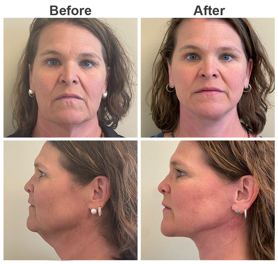 Cerelax V-Edge Patches™